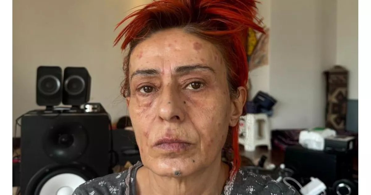 Yıldız Tilbe'nin yüzünde yanıklar oluştu... Görüntüsü korkuttu